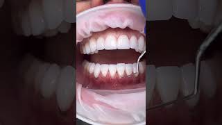 How thin are porcelain veneers 👆🦷 veneers bottom dentist health teethclean 🦷beadrepair [upl. by Puiia]