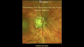 Advanced Glaucoma Optic Disc Changes glaucoma eyedisease [upl. by Ydurt601]