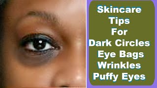 Dark Circles Eye Bags Puffy Eyes Wrinkles And Crows Feet Tips [upl. by Zachery]