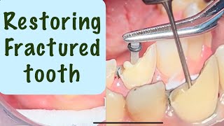 Tooth Fracture Restoration with composite amp fiber post [upl. by Okkin479]