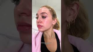 Dissolving my Lip Filler 💗 vlog lipfiller [upl. by Lalib]