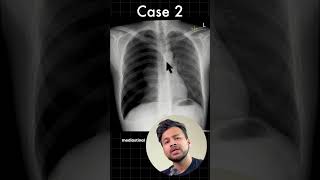 pneumoperitoneum pneumothorax emergency neetpg inicet dranujaggarwal [upl. by Norrek]