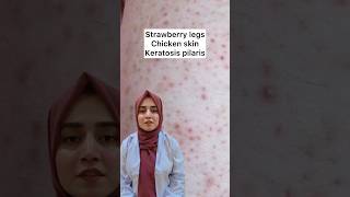 How to get rid of keratosis pilaris  strawberry legs or chicken skin Free medical advice Day9 [upl. by Farmer]