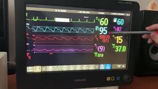 Medición de la Saturacion de oxigeno Monitor Intellivue MX700 de Philips [upl. by Fraze118]