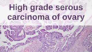 High Grade Serous Carcinoma of Ovary  Pathology mini tutorial [upl. by Haidej]