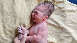 Newborn baby with big Elongated Head immediately after birth due to difficult delivery [upl. by Notyap]