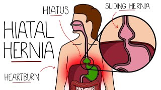 Hiatal Hernia Explained Hiatus Hernia [upl. by Nylirac]