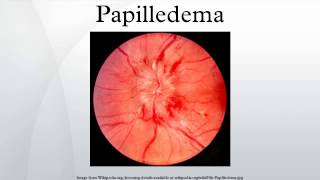 Papilledema [upl. by Kilian]