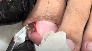 Treatment for Ingrown Toenails 004 satisfying nailsAlphanalis HCM [upl. by Sander799]