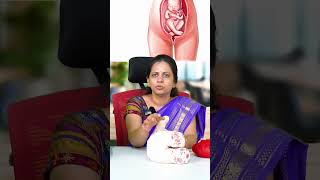 What is Breech Delivery  Dr Shilpa G B Gynecologist [upl. by Jermayne257]