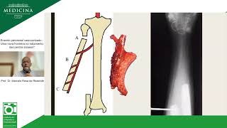 Enxerto periosteal vascularizado  Uma nova fronteira no tratamento das perdas ósseas [upl. by Ferrell]