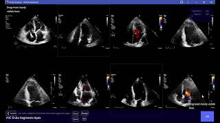 Ranking A4C echo images based on the visibility of the Endocardial Segments [upl. by Guthrie]