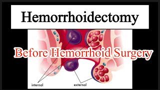 Hemorrhoidectomy  Hemorrhoid Surgery  Hemorrhoid removal hemorrhoidectomy hemorrhoids bastrop [upl. by Paik]