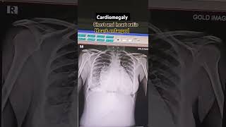 Cardiomegaly xray findings Cardiomegaly Heart Enlarged xray chestheartchestxray [upl. by Nhguav]