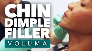 Cleft Chin Dermal Filler  Chin Dimple Filler  Los Angeles [upl. by Wahs]