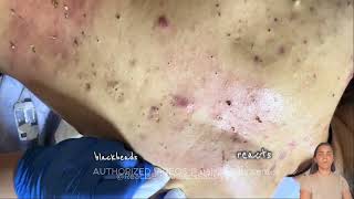 blackhead removal blackheads removal blackhead blackheads blackheads lips blackheads around lip [upl. by Sel729]