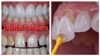 Dental VeneersTeeth VeneersCosmatic Dentistry [upl. by Kooima]