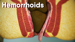 Hemorrhoidsdifferent types of hemorrhoids internal and external Hemorrhoids Hemorrhoids treatment [upl. by Nnaeirrac947]