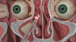 Chapter 3 Nasal and Sinus Problems and Solutions [upl. by Gitt]