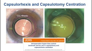 Capsulotomy Video of the Month [upl. by Ricca]