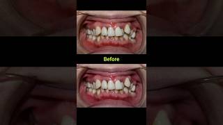 24 months braces for crooked teeth braces dentist orthodontist dental [upl. by Malena]