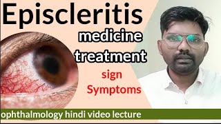 Episcleritis treatment  Episcleritis disease in eye  sclera anatomy  Episcleritis  optometry [upl. by Thea145]