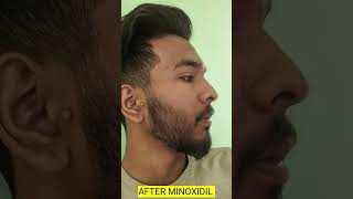 minoxidil beard transformation  minoxidil beard growth journey minoxidil beard beardgrowth [upl. by Aramoy982]