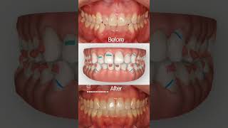 Invisalign for crooked teeth invisalignbeforeandafter invisalignsmile invisaligntreatment [upl. by Sakram777]