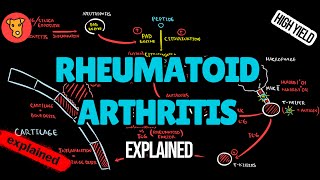 RHEUMATOID ARTHRITIS Pathogenesis EULAR Guidline diagnostic criterias Xray Treatment [upl. by Yennor506]