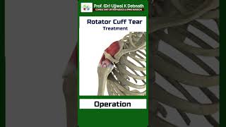 Treatment of rotator cuff tear   Dr Ujjwal K Debnath [upl. by Flieger]