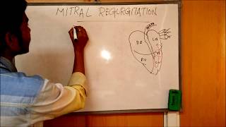 MITRAL REGURGITATION  DEFINITIONCAUSESSIGNSSYMPTOMSPATHOPHYSIOLOGY AND TREATMENT [upl. by Ekrub211]