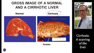 CIRRHOSIS LIVER SCARRING by Dr Robert Gish [upl. by Raclima]