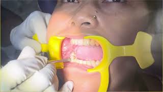 Mandibular Right First Molar Extraction dentistrydentist trending youtube oralsurgery [upl. by Gardner]