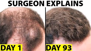 Oral Minoxidil  A Better Hair Loss Treatment [upl. by Aiden]