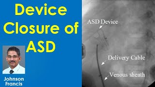 Device Closure of Atrial Septal Defect ASD [upl. by Adlee243]