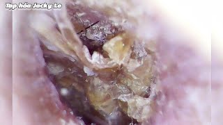 Ear Wax Removal 120 Earwax Makes Me itch Like Crazy Please Take It Out  Ear Cleaning ASMR [upl. by Raddi468]