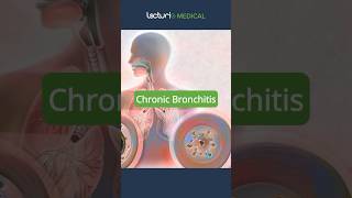 Understanding Chronic Bronchitis 🌬️ ChronicBronchitis MedEducation usmlestep [upl. by Sokcin]