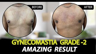 Gynecomastia Grade 2B Surgery in Jaipur  Patient Feedback  Rejuvena Cosmo Care [upl. by Inatirb]