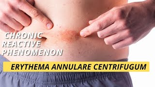 Erythema Annulare Centrifugum [upl. by Ohploda]