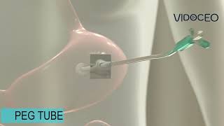 Percutaneous Endoscopic Gastrostomy PEG feeding tube animated explanation [upl. by Tonie]