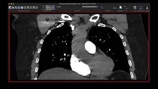 Anatomia na radiografia de tórax [upl. by Adianez]