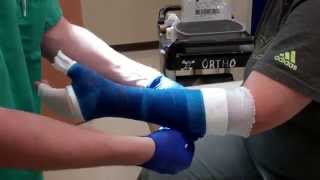 Application of a Thumb Spica Cast [upl. by Elyod48]