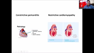 Constrictive Pericarditis amp Restrictive Cardiomyopathy by Dr Nur Alam sir [upl. by Oinimreh380]