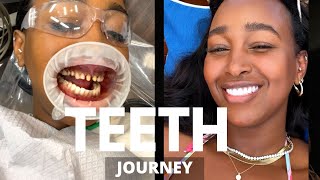 MY TEETH JOURNEY  I GOT PORCELAIN VENEERS  BEFORE AND AFTER PHOTOS  DR NEAL PATEL  THE YUSUFS [upl. by Bacon945]