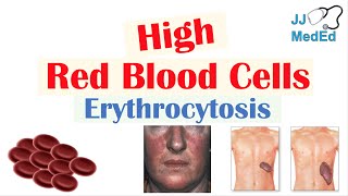 High Red Blood Cells Erythrocytosis  Causes Signs and Symptoms and Treatment [upl. by Hafinah475]