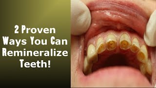 2 Little Known Ways To Achieve Tooth Remineralization Easy To Implement [upl. by Eisdnyl]