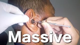 Removing Officers Massive Impacted Earwax without Earwax Softener [upl. by Enia273]