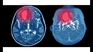 Guía 2022 para el manejo de pacientes con hemorragia intracerebral espontánea [upl. by Clarey]