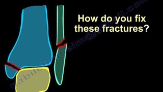 Ankle Fractures Surgical Treatment tactics  Everything You Need To Know  Dr Nabil Ebraheim [upl. by Kepner629]