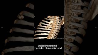 Osteochondroma  right 4th rib anterior end ctchest 3dnimation [upl. by Noval]